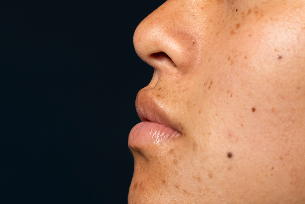 Hyperpigmentation Causes & Treatments: How to Get Even Skin Tone